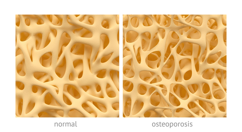 hueso con estructura normal y con estructura en la osteoporosis